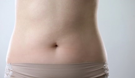 מתיחת בטן - תמונת המחשה